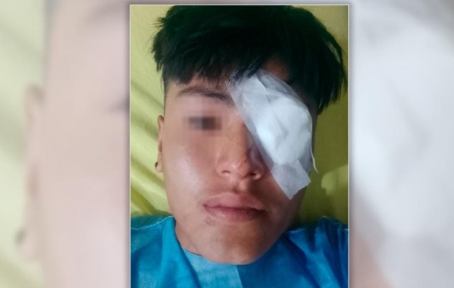 Jujuy Un Menor Perdi Un Ojo Por Una Bala De Goma Que Recibi En La